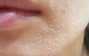 Làn da vào thu: Bí quyết dưỡng ẩm và chăm sóc da mụn nhạy cảm tại nhà